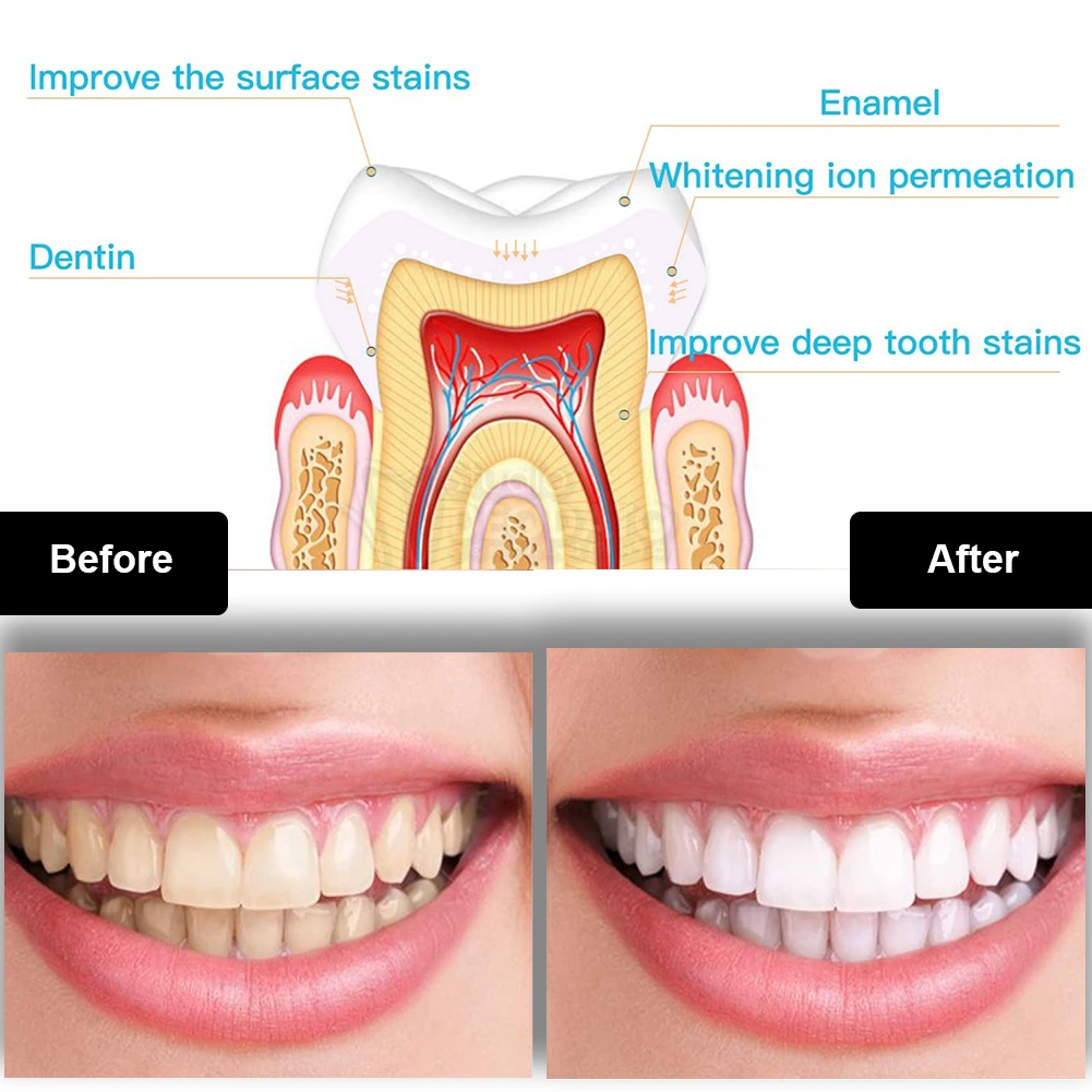 歯科歯ホワイトニングキットミニ 16 LED コールドライト - Teeth Whitening Gel Pen のレビューと価格