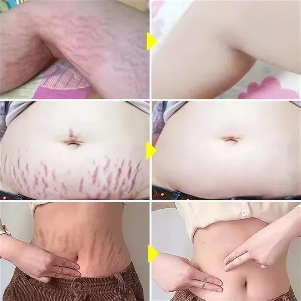 100 グラムストレッチマーク永久除去クリームマタニティ妊婦 - Teeth Whitening Pregnancy のレビューと価格